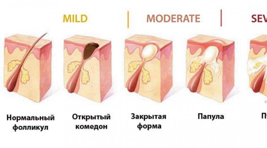 Прыщ в разрезе картинка