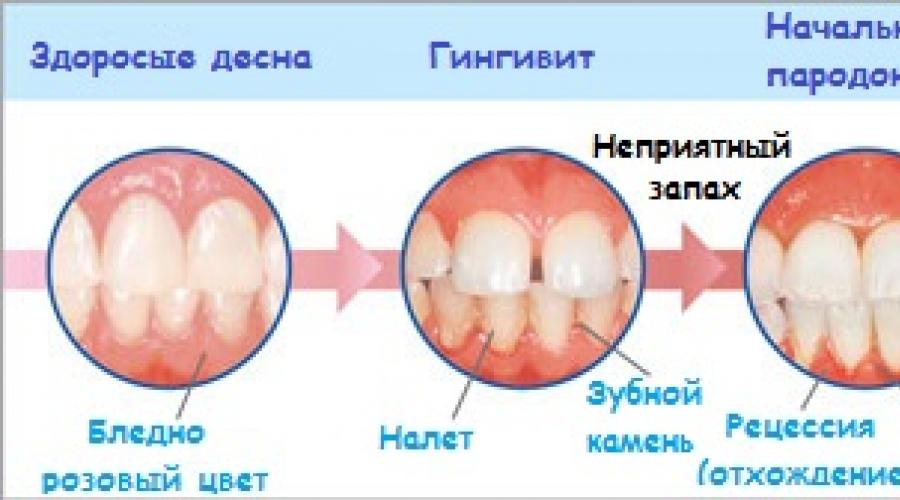Шинирование зубов: виды и особенности стоматологической процедуры. В чем заключается процедура шинирования зубов, какие показания и методики