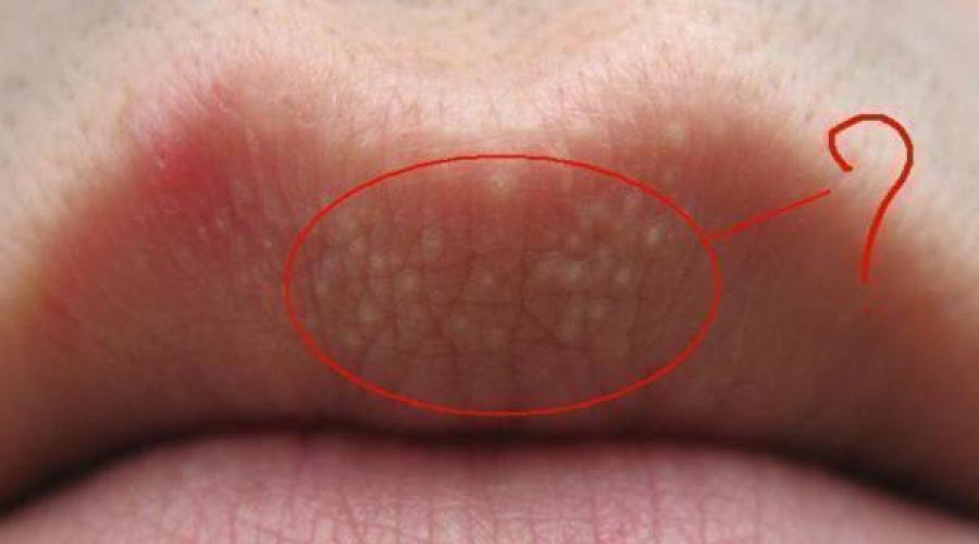 Как бороться с болезнью фордайса на губах. Эффективные средства для устранения гранул фордайса